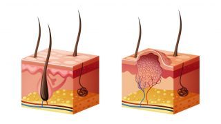 Cinsel Organda Siğil çıkması tedavisi | HPV | Human Papillomavirus | Remzi Erdem | Kadir Tepeler | Ürolife