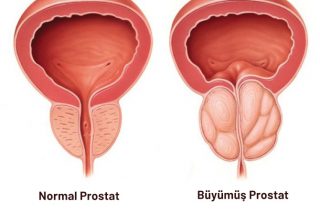 “Prostat Büyümesi Nedir? Prostat Neden Büyür? Prostat tedavisi, en iyi doktor, Kadir Tepeler, Ürolife”