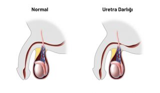 Uretra Darlığı tedavisi | Açık uretra ameliyatları | Remzi Erdem | Kadir Tepeler | Ürolife